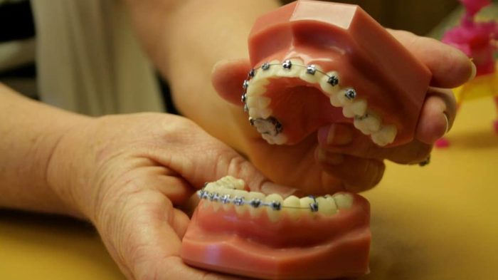 braces mold