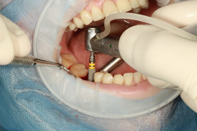 dental implants procedure