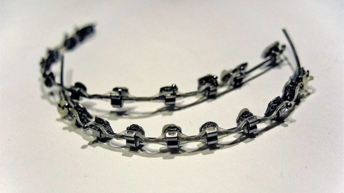 metal braces