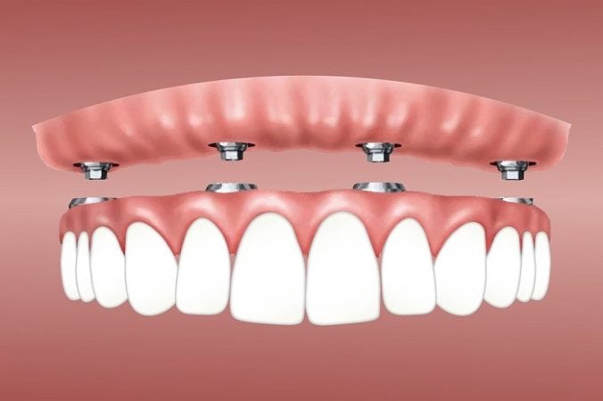 dental implant graphic