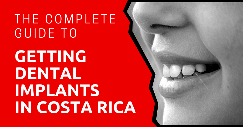 The Complete Guide to Getting Dental Implants in Costa Rica