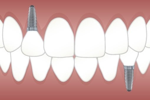 available dental implants type