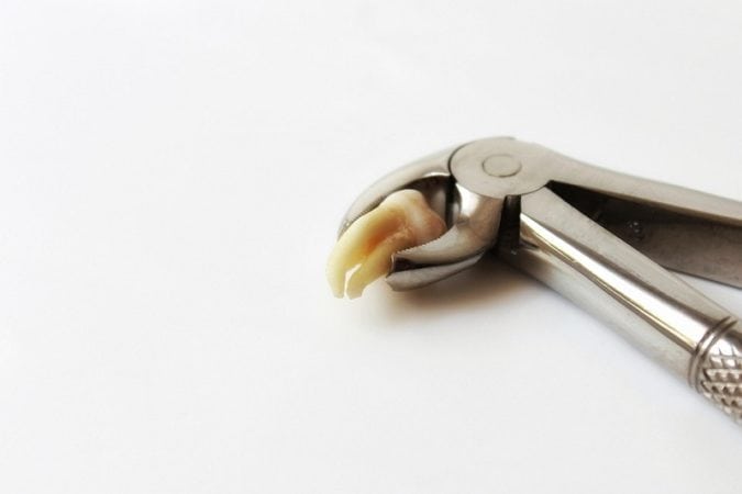 Tooth removal