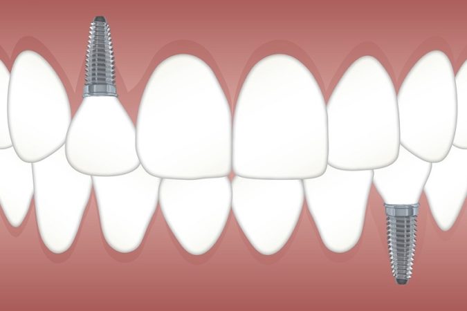 dental implants visual 