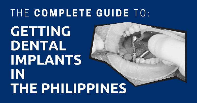 The Complete Guide to Getting Dental Implants in the Philippines