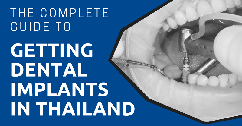 The Complete Guide to Getting Dental Implants in Thailand