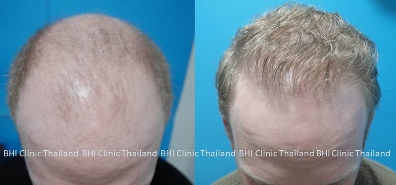 before and after getting hair transplant at BHI clinic