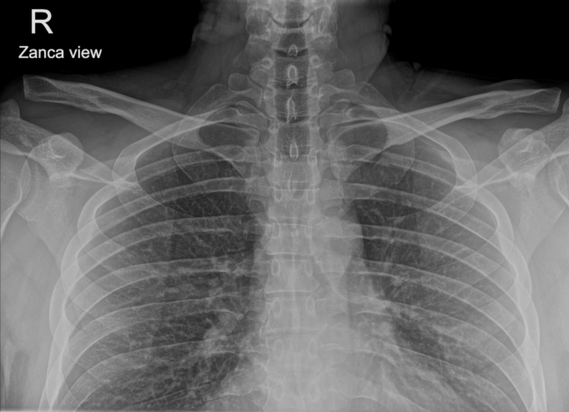 my first x-ray before the surgery